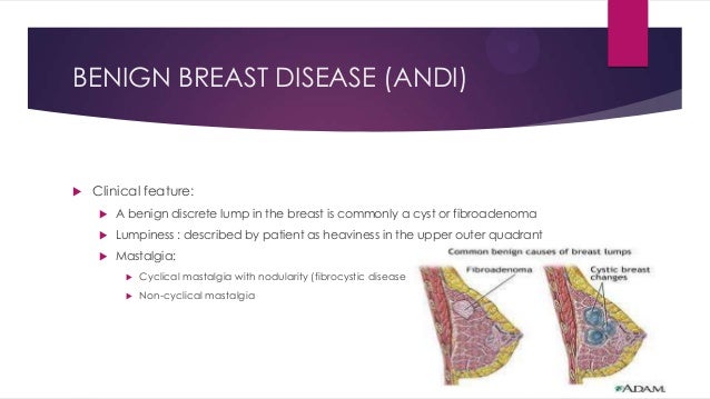 breast non cancerous Breast non cancerous